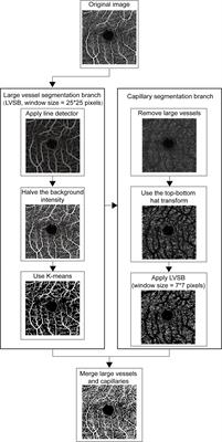 Association Between the Severity of Diabetic Retinopathy and Optical Coherence Tomography Angiography Metrics